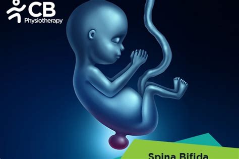 bufuda|Spina Bifida: Causes, Symptoms, Diagnoses, and Treatment